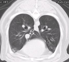 A controlled trial of sildenafil in advanced idiopathic 