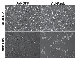 Osteosarcoma Cells in Modiano Clinical Trial