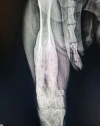 X-ray of Liz's femur