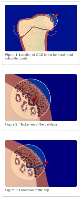 Three diagrams demonstrating the development of an osteochondrosis cartilage defect.